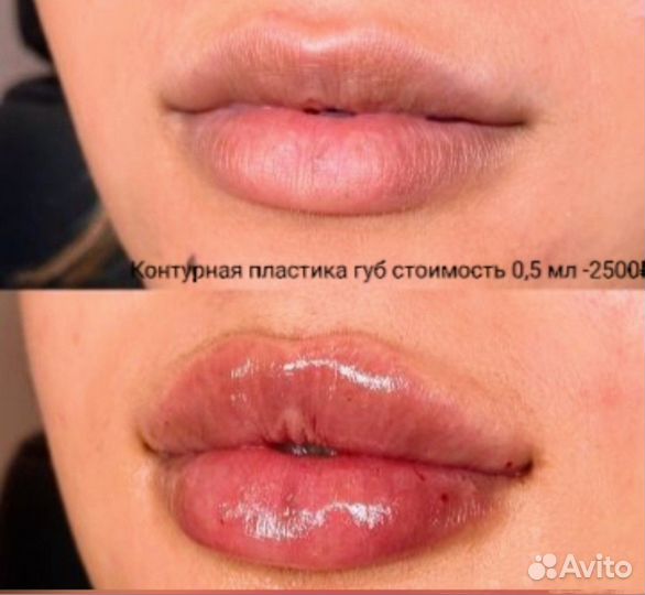 Увеличение губ