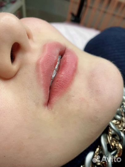 Увеличение губ