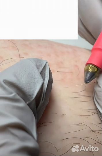 Электроэпиляция
