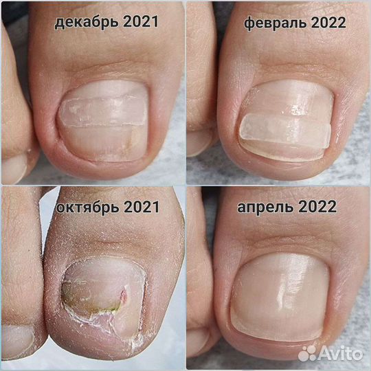 Медицинский педикюр,подолог, вросшие ногти