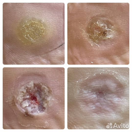 Лечебный педикюр подолог