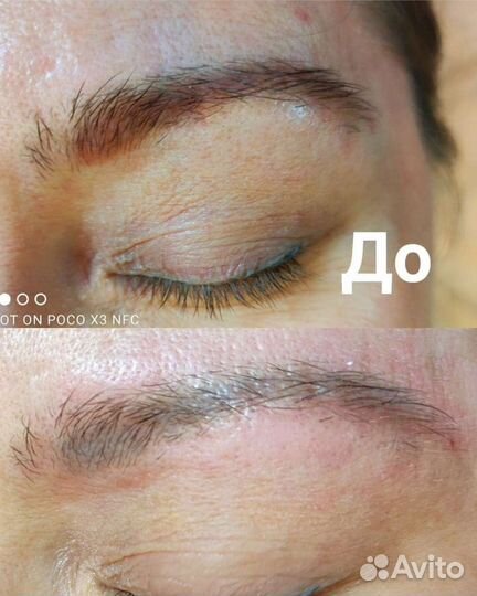 Удаление татуажа и татуировок. Лазер. Ремувер