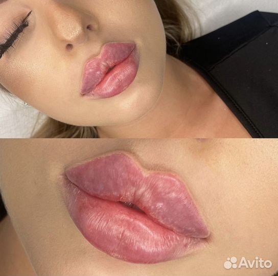 Увеличение губ