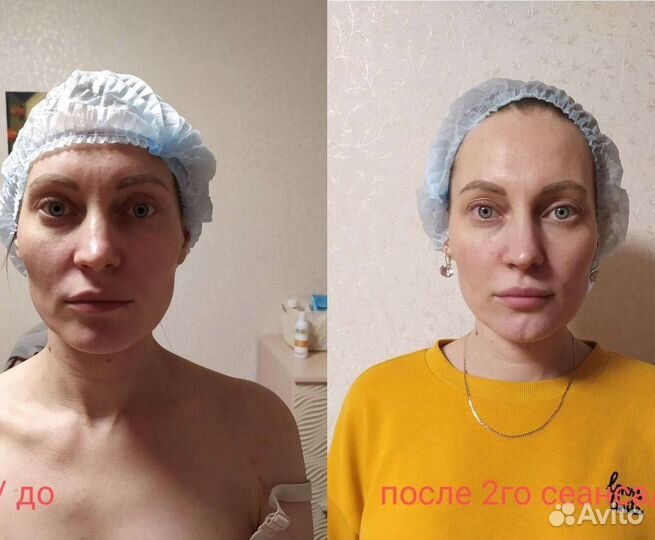 Массаж лица / Массаж ШВЗ /Массаж спины