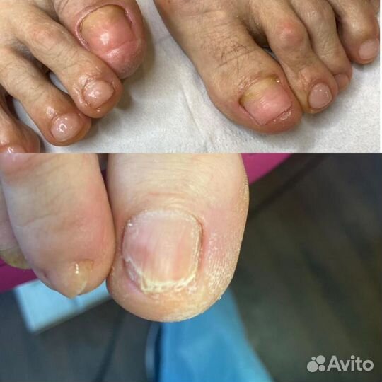 Медицинский педикюр, подолог