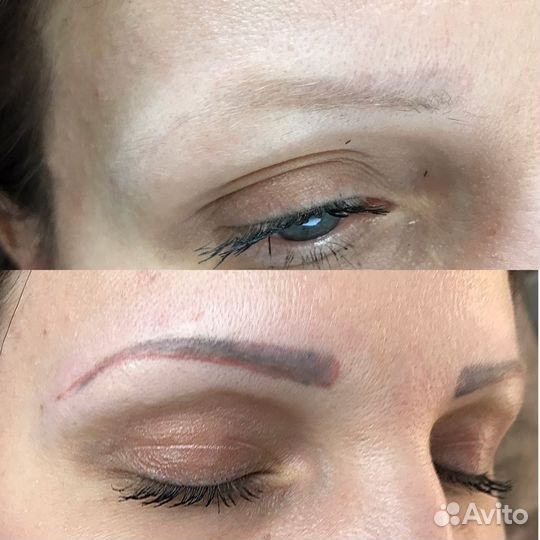 Удаление татуажа лазером