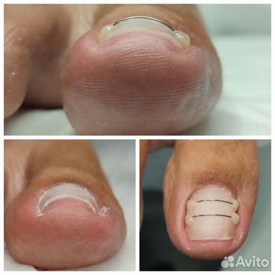 Парамедицинский педикюр, подолог