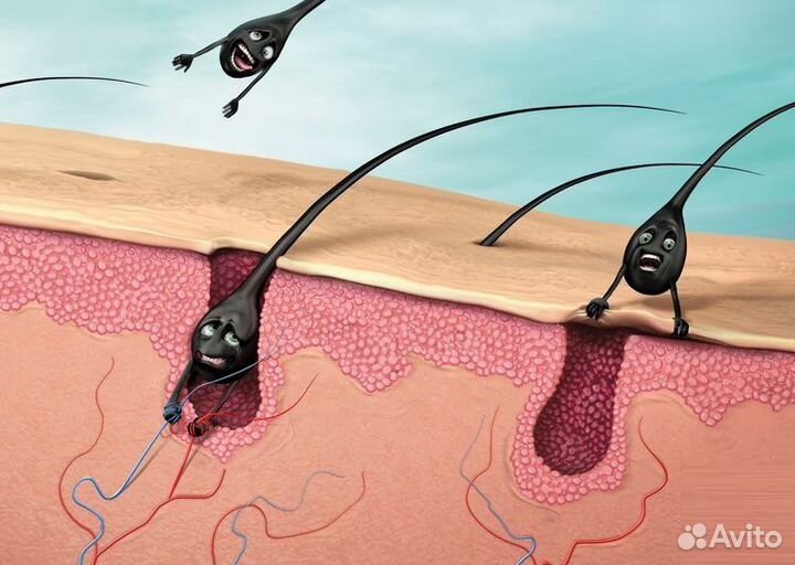 Электроэпиляция