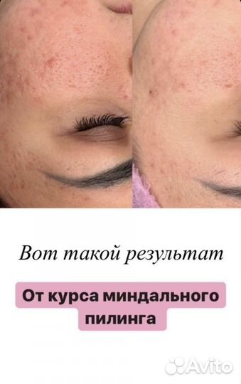Косметолог чистка лица лечение акне