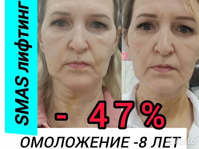 СМАС лифтинг Омоложение Косметология