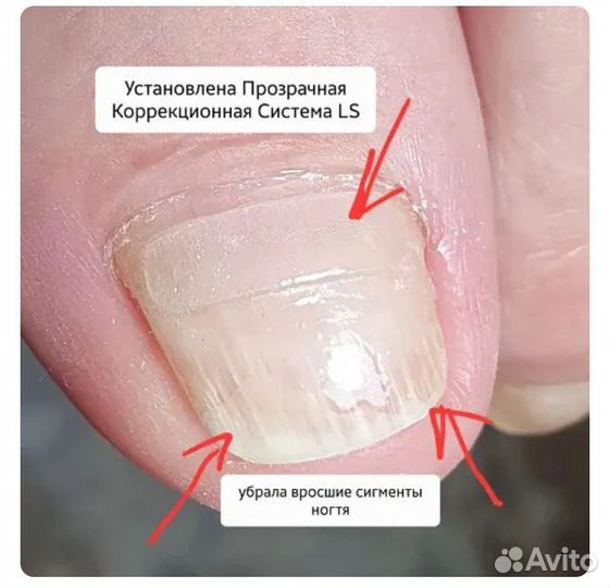 Вросший ноготь. Установка коррекционной системы