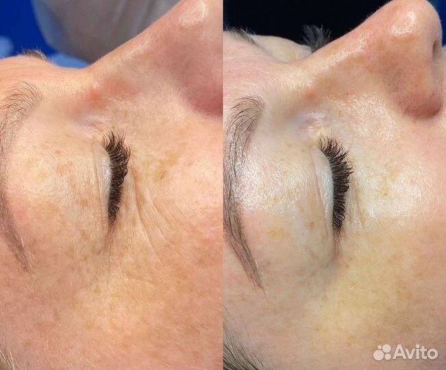 Пилинг LET для глаз и губ