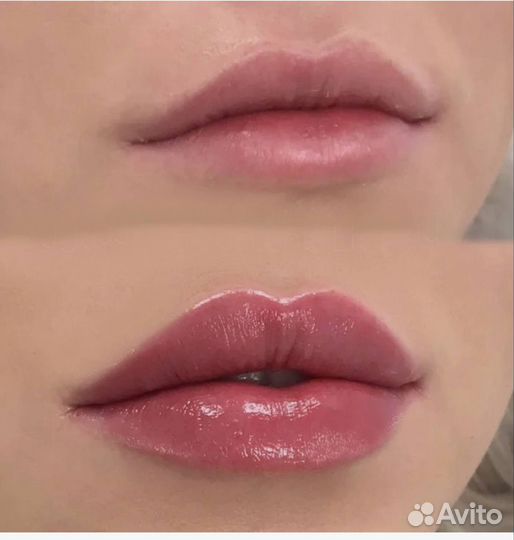 Увеличение губ