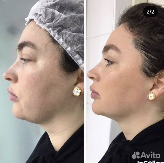 Коррекция фигуры с гарантией результата