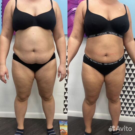 Массаж Vela Shape, круче чем LPG