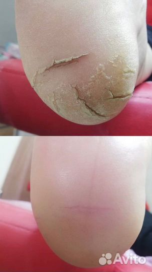 Услуги подолога / педикюр