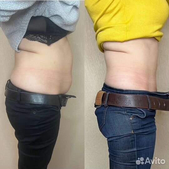 Липолитики лицо, тело