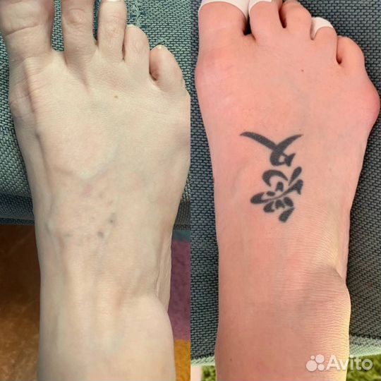 Удаление тату Лучший Лазер в Иваново