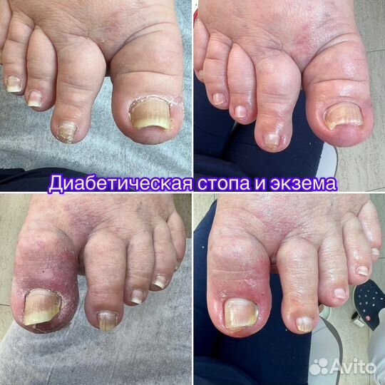 Подолог (вросший ноготь, мозоли, трещины)