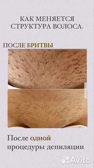 Эпиляция лазерная