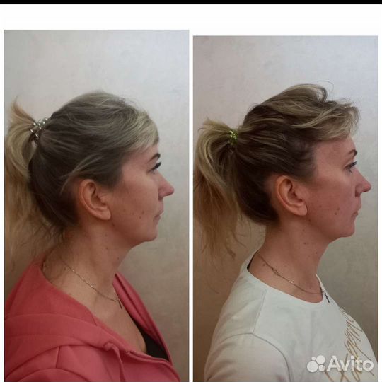 Витапластика. Массаж лица