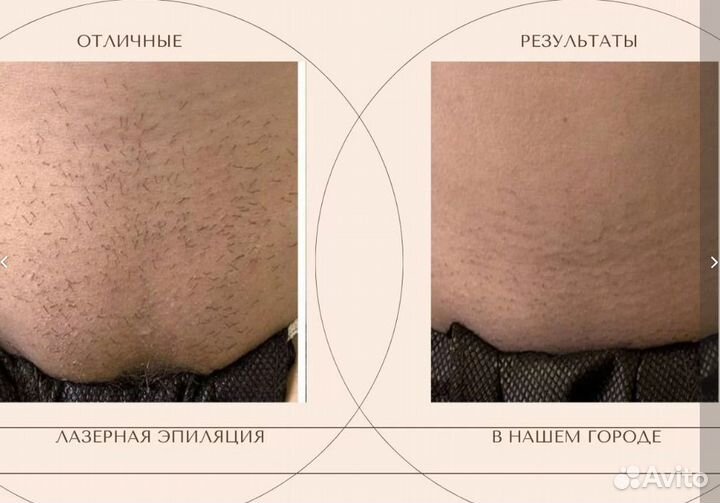 Лазерная эпиляция александритовая+диодная волна