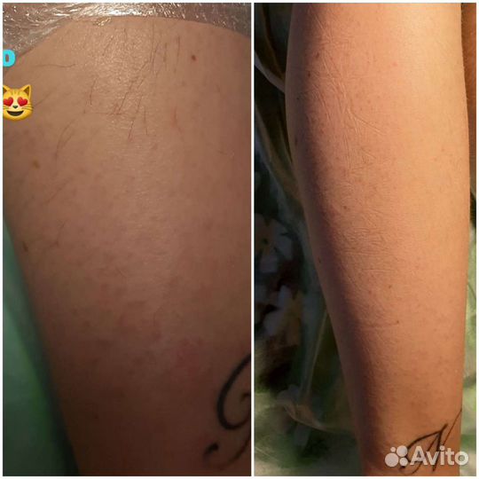 Электроэпиляция