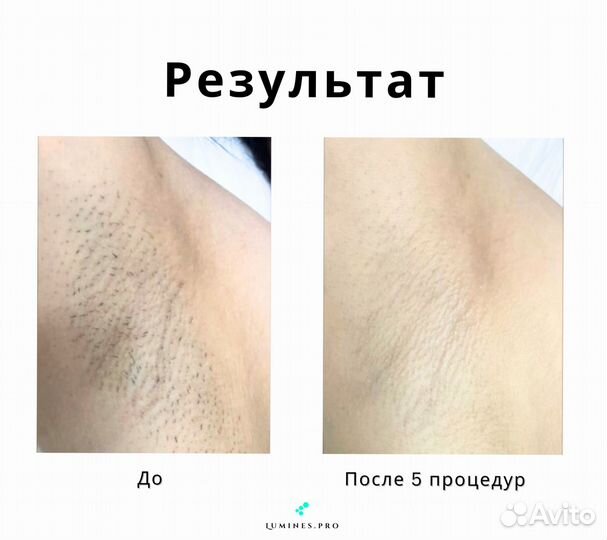 Диодный лазер для эпиляции Люминес’ Макс’Ван 1200 Вт