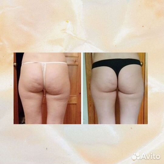 Антицеллюлитный массаж