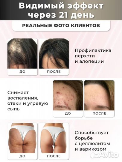 Аппарат Дарсонваль для лица тела и волос