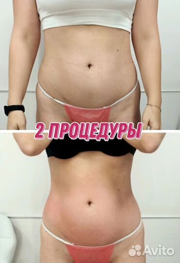 Антицеллюлитный массаж