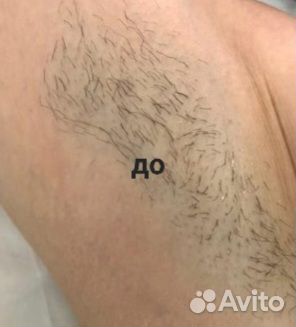 Микроигольчатый РФ лифтинг