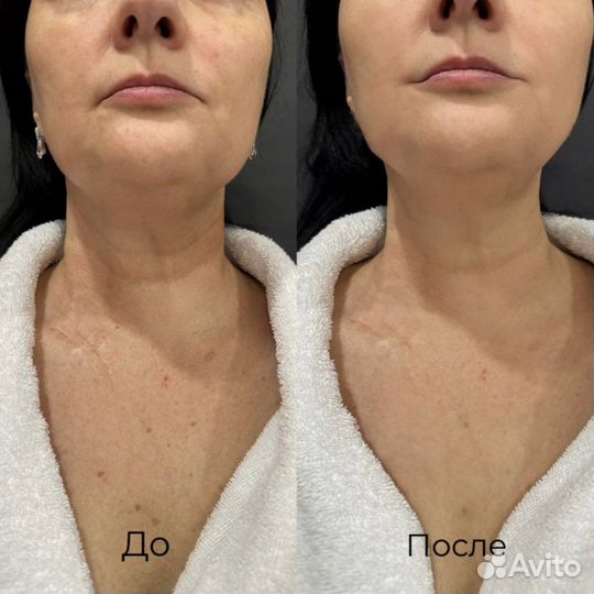 Аппаратный массаж