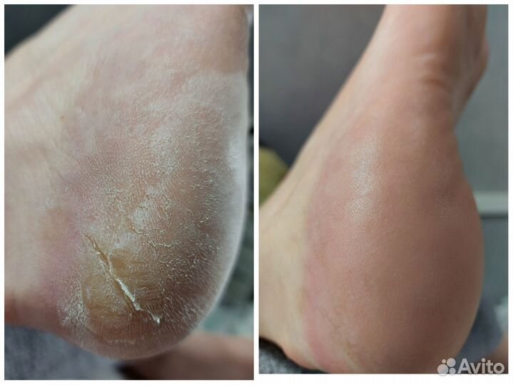 Педикюр(Smart)