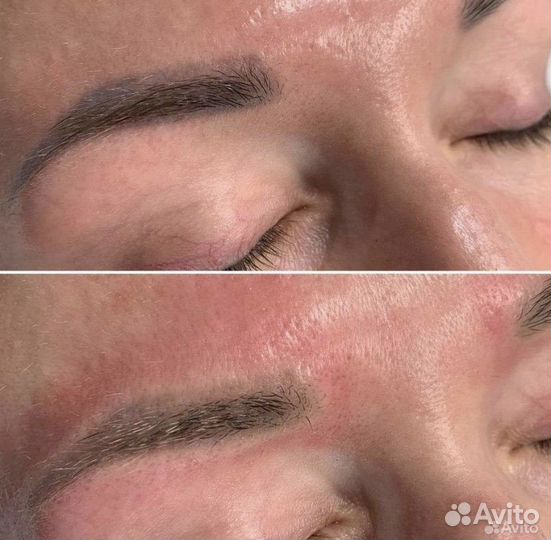 Удаление татуажа и татуировок в Благовещенске