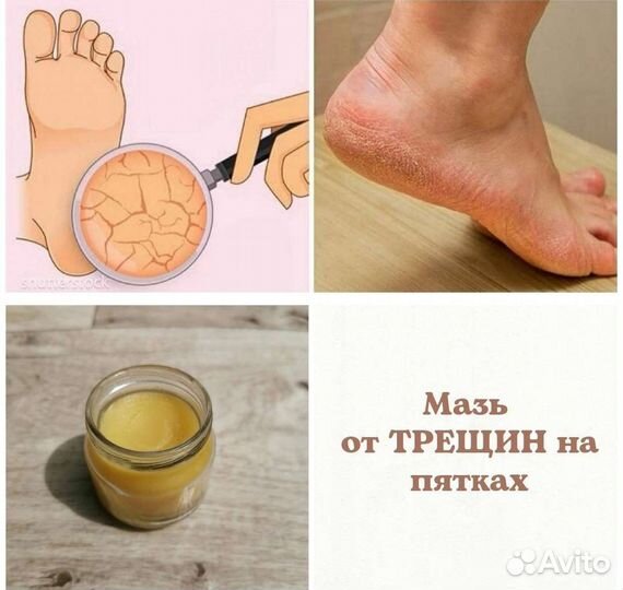 Мазь для Пяток, от трещин на пятках, стопах