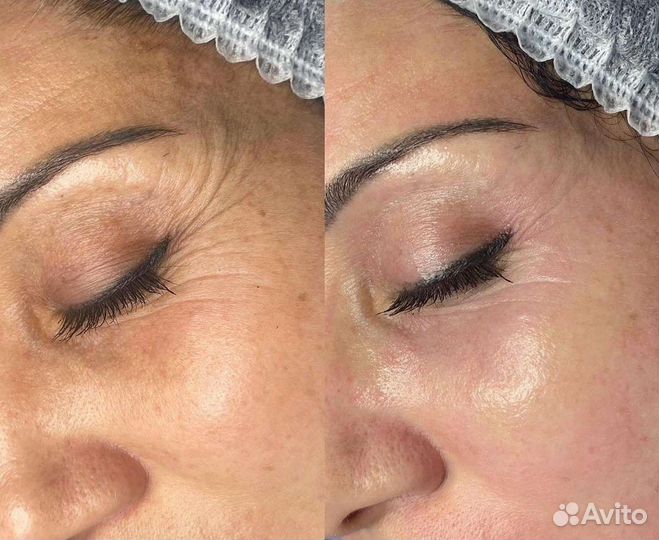 Пилинг LET для глаз и губ