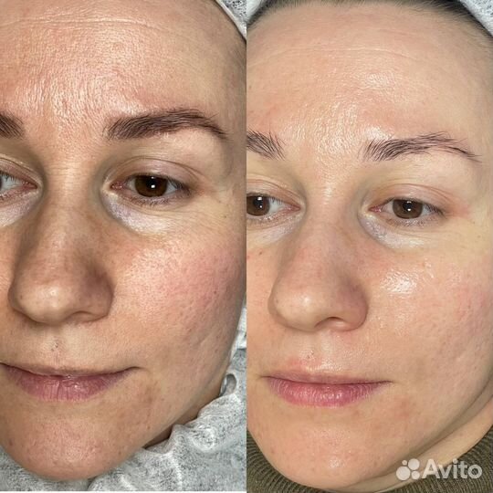 Ферментотеоапия FlaxEnzyme