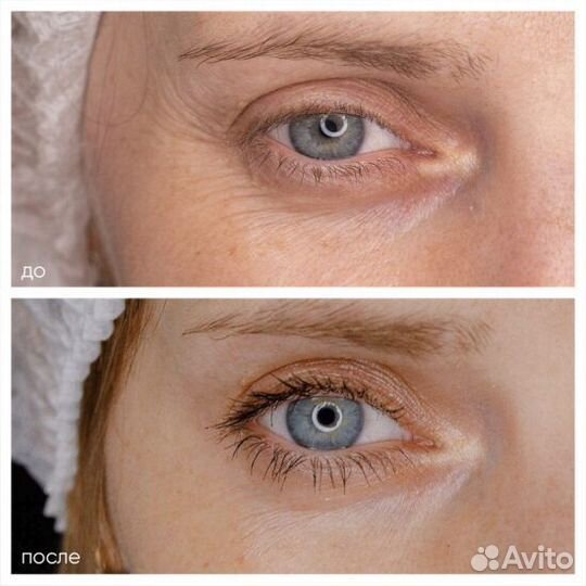 Устранение мешков под глазами