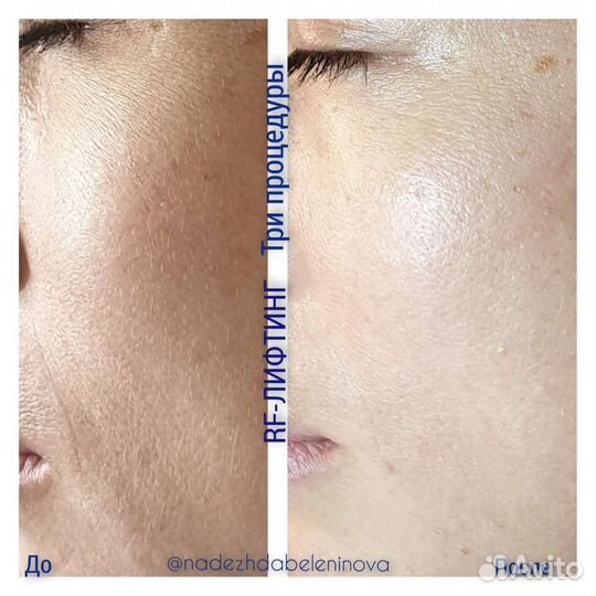 Вакуумный массаж, Кавитация, RF лифтинг