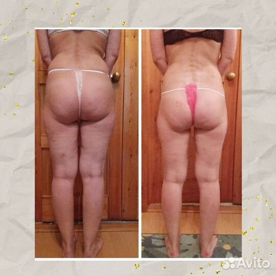 Антицеллюлитный массаж