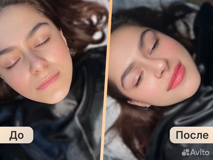 Контурная пластика губ. Косметолог