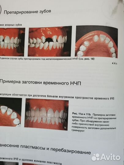 Несъёмное протезирование зубов Цветной атлас