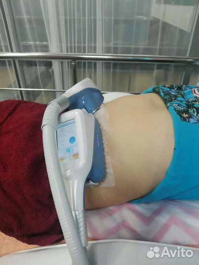 Криолиполиз процедура