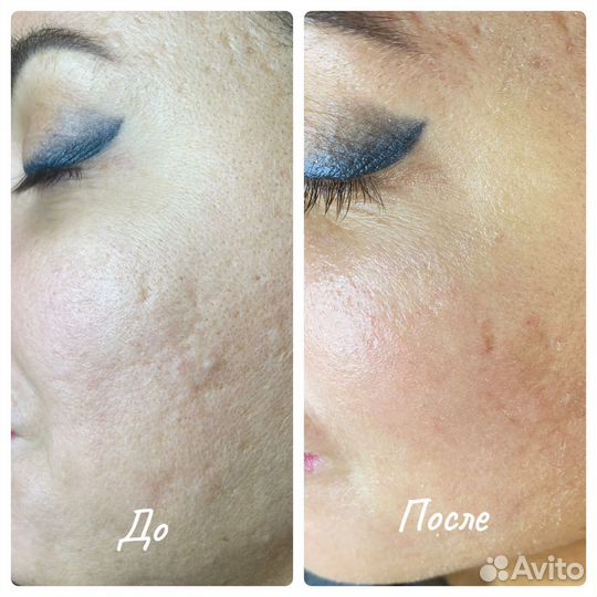 Дарсонвализация