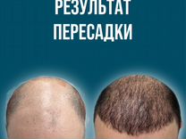 Пересадка бровей, бороды, волос м.Динамо