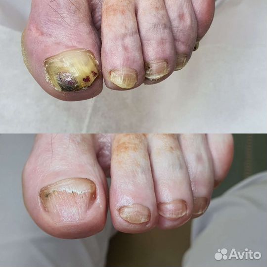 Педикюр, подолог, трещины,натоптыши,грибок и т.д