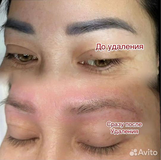 Удаление татуажа лазером