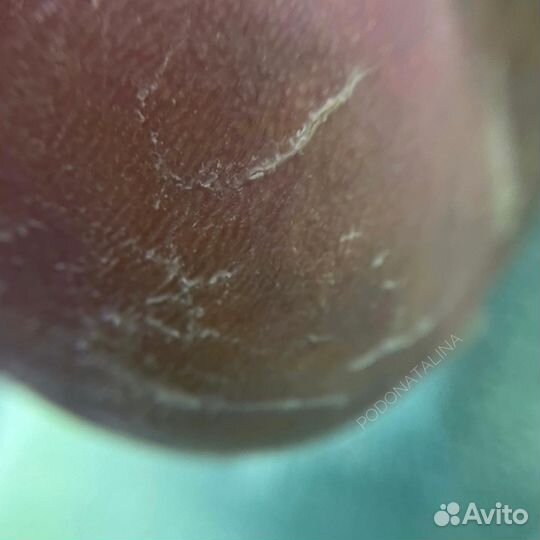 Модель подологу вросшие ногти трещины травмы