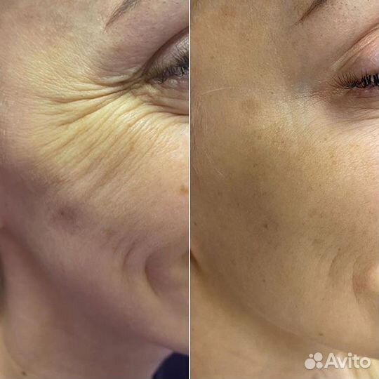 Ботокс лица